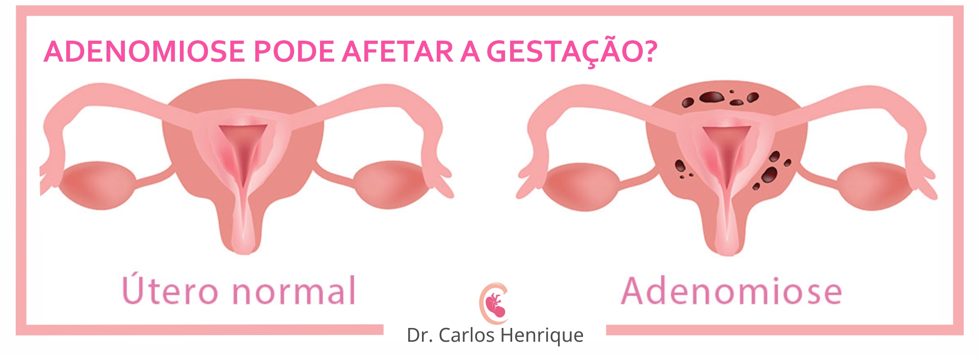 Leia mais sobre o artigo ADENOMIOSE PODE AFETAR A GESTAÇÃO?